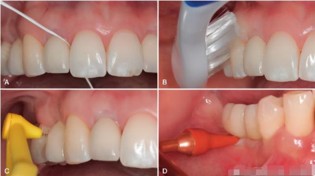 对于种植牙的日常维护，患者及医生的操作区别有点大