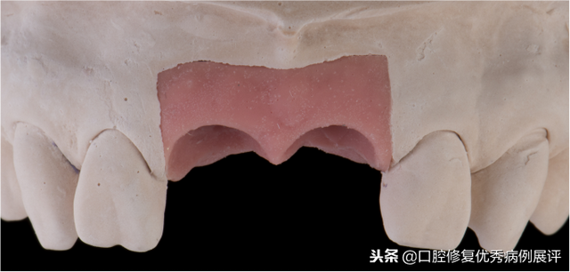 展评优秀病例赏析｜Asc全瓷角度基台一体冠进行种植前牙美学修复