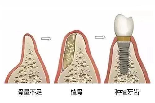 决定种植牙的成功率，牙槽骨为何如此重要？