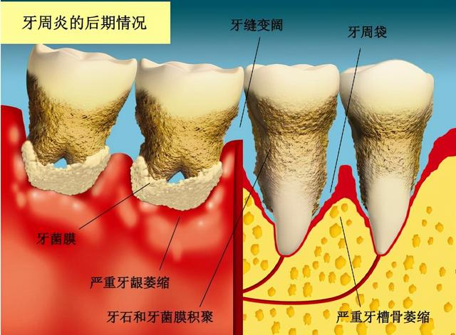 种植专家：不可盲目种牙，这些人不建议种牙