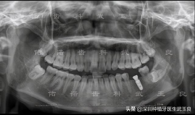 深圳种植牙：年度经典种植牙案例之牙齿龋坏，奥齿泰植体篇