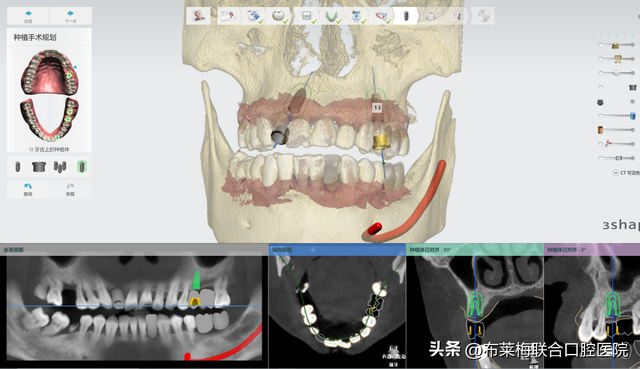 带父母去种牙，千挑万选最后竟然选择了数字化种植技术