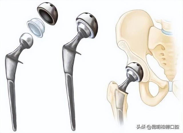 种植牙的材质是什么？看完都能放心种牙了