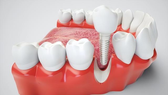 国家医保盯上了口腔种植，单颗种植不超4500，暴利行业将被终结