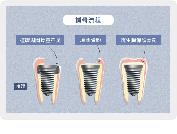 冷知识：你猜种植牙植骨粉一次多少钱？按克收费堪比黄金