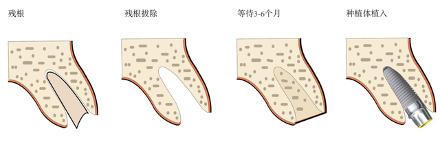 即拔即种，让牙齿立刻变美