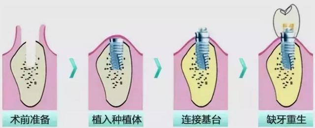 种牙痛吗？种植牙需要多长时间？