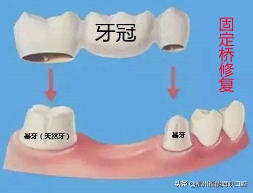 缺牙后2个结果难承受！假牙、种植牙价格相差百倍？牙医带你选