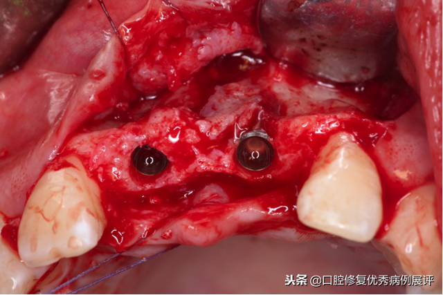 展评优秀病例赏析｜Asc全瓷角度基台一体冠进行种植前牙美学修复