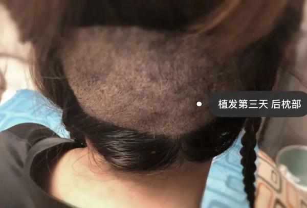 “秃”然提问：腿毛可以植发到头上吗？