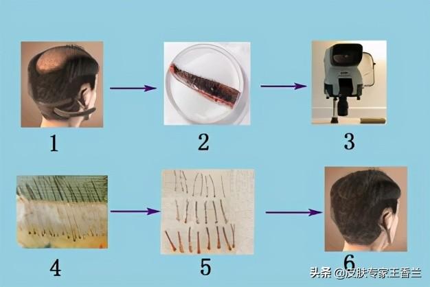 听说植发种的头发第二年就掉完了？皮肤科医生来告诉你真相