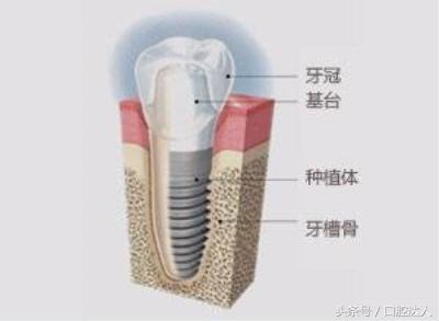 种一颗牙要多长时间呢？