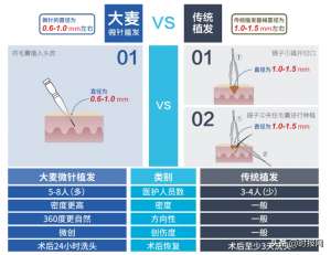 那个种植头发较好(大麦植发，让头发悄然变美的“针”帮手)