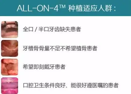 全口缺失牙，全口即刻修复种植牙技术