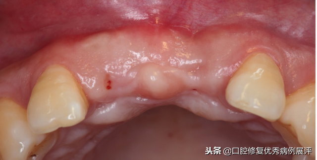 展评优秀病例赏析｜Asc全瓷角度基台一体冠进行种植前牙美学修复