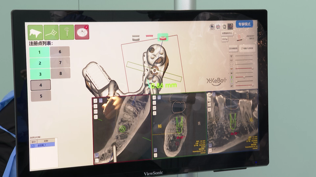 机器人“牙医”亮相乐清 完成温州首例自主式机器人种植牙手术