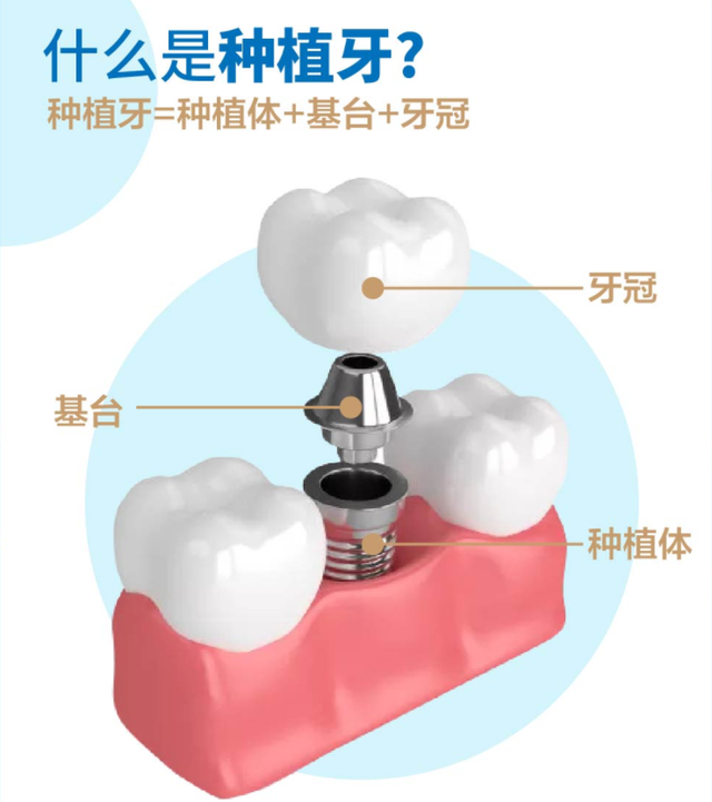 喜讯！种植牙费用大“瘦身”，至今寿命最长的有56年！
