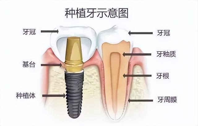 什么是种植牙？种牙有什么风险和后遗症？