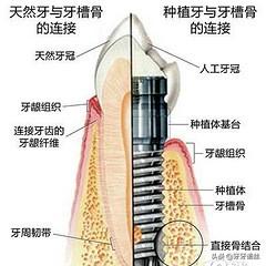 种植牙术后就可以大快朵颐吗？不是的，术后护理全在这里了