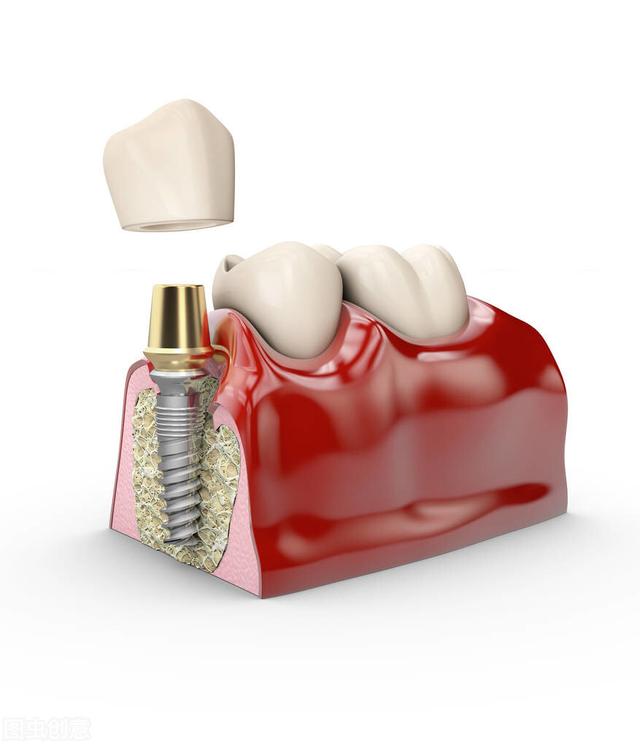 做完种植后，疼痛会持续多久？看看专业牙医的说法