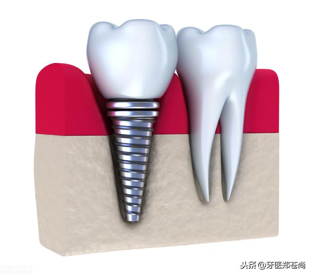老人做种植牙会不会有副作用？