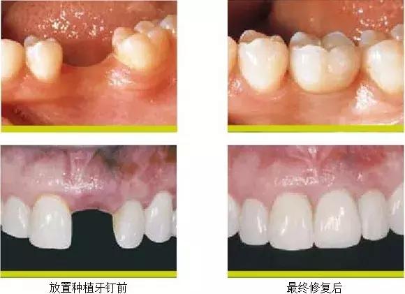 当种植牙遇上香烟，你怕了吗？