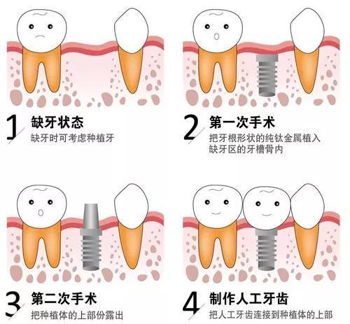 我的牙齿坏掉了，艰难的种植之路