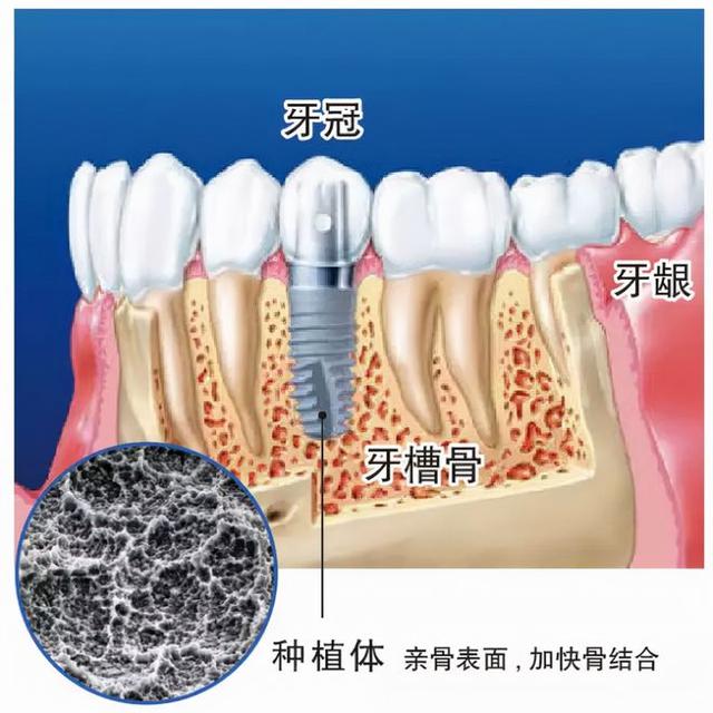 种牙行内人为您揭秘丨亲水种植真的比非亲水种植好吗？是智商税吗