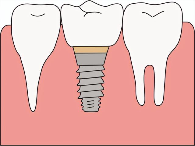 种植牙与真牙存在三点区别，术后饮食需注意