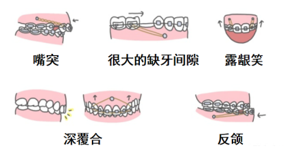 不懂就问：打骨钉痛不痛？