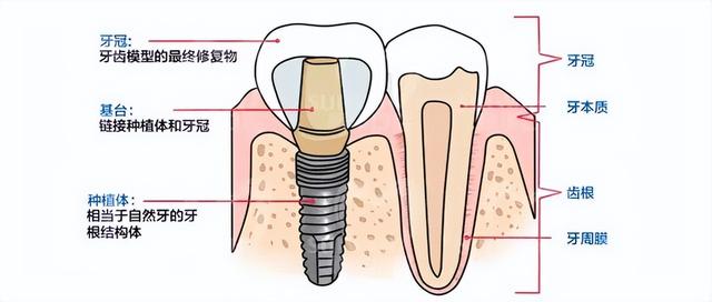 想种牙又担心失败？这份种植牙攻略看完赶紧收藏