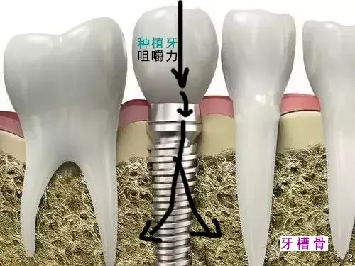 为什么我的牙齿状况种牙最好？烤瓷牙和种植牙这样选！