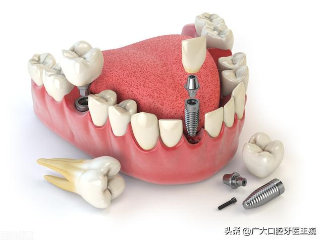 种牙要花多少钱？知名牙科医院报价出来了