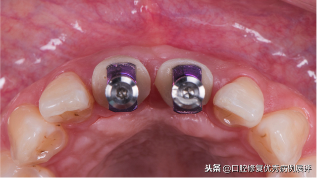 展评优秀病例赏析｜Asc全瓷角度基台一体冠进行种植前牙美学修复