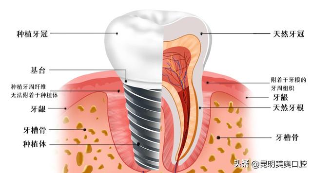 种植牙和天然牙对比，种植牙真的能代替真牙吗？