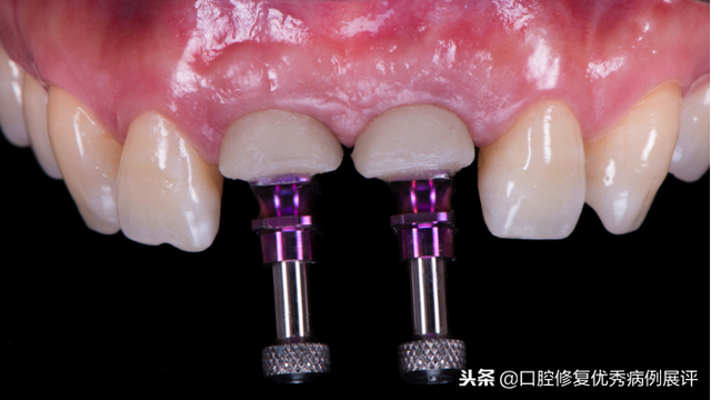 展评优秀病例赏析｜Asc全瓷角度基台一体冠进行种植前牙美学修复