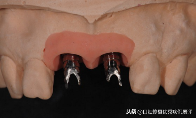 展评优秀病例赏析｜Asc全瓷角度基台一体冠进行种植前牙美学修复