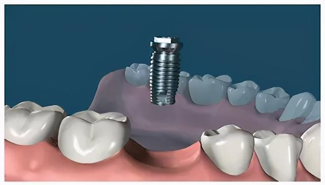 种植牙的全过程，先来了解一下，让你以后种牙不再慌