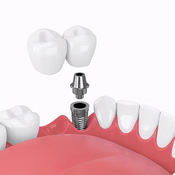 种牙后出现这3种问题，有可能是种植牙失败了