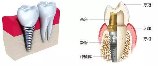 种了牙还吸烟？这个习惯很可能导致你新牙报废