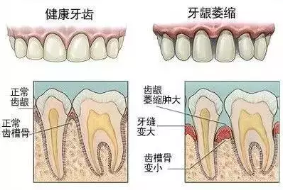 快停下来！这些操作激增牙龈萎缩风险，而你每天都做！