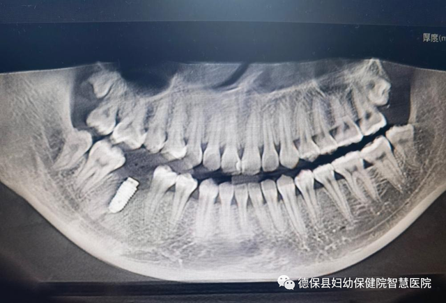 德保县妇幼保健院口腔科成功开展首例种植牙及同期植骨术