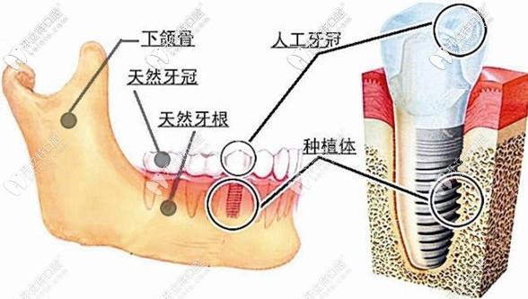 快收藏这份苏州种植牙价格表，在牙科医院种牙准能用得上