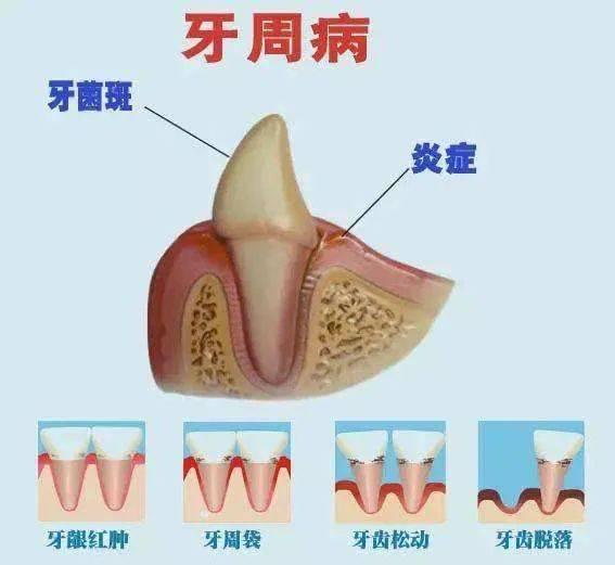 快停下来！这些操作激增牙龈萎缩风险，而你每天都做！