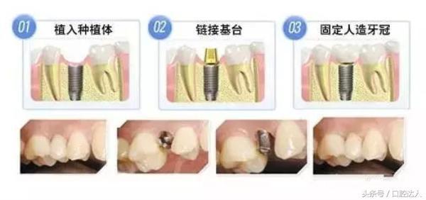 亲身经历：种植牙是可以用一辈子的