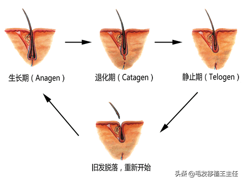 植发一个月，头发疯狂掉落，到底是怎么回事？