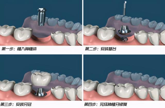 为什么别人一来就可以种牙，而我还要等上3个月？医生：行业机密