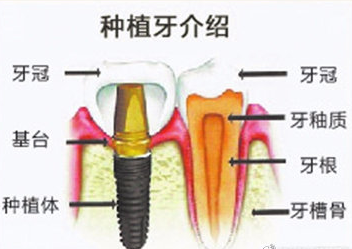 科普｜关于种植牙的“冷知识”，你想知道的都在这