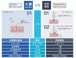 种植头发哪个较好(你想要的美丽发际线，大麦植发能实现)