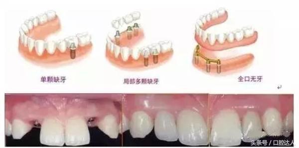 亲身经历：种植牙是可以用一辈子的